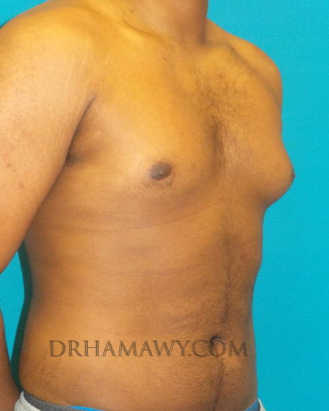 Male Chest Enhancement Before and After | Princeton Plastic Surgeons