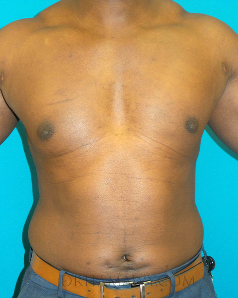 Male Chest Enhancement Before and After | Princeton Plastic Surgeons