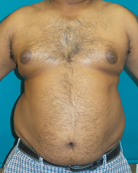 Male Chest Enhancement Before and After | Princeton Plastic Surgeons