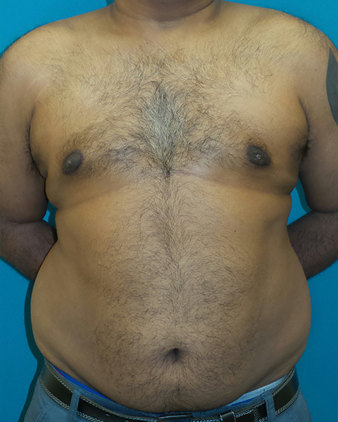 Male Chest Enhancement Before and After | Princeton Plastic Surgeons