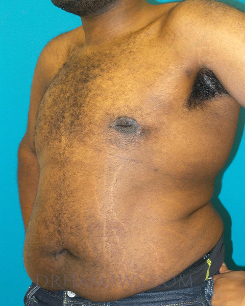 Male Chest Enhancement Before and After | Princeton Plastic Surgeons