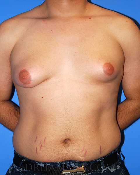 Male Chest Enhancement Before and After | Princeton Plastic Surgeons