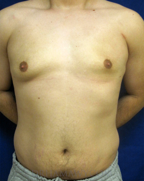 Male Chest Enhancement Before and After | Princeton Plastic Surgeons