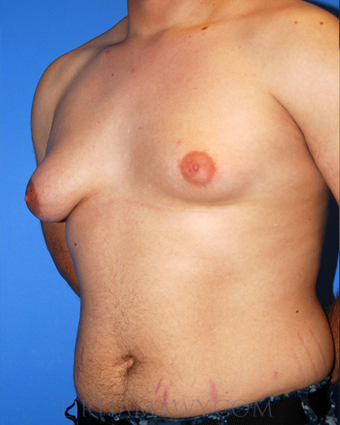 Male Chest Enhancement Before and After | Princeton Plastic Surgeons