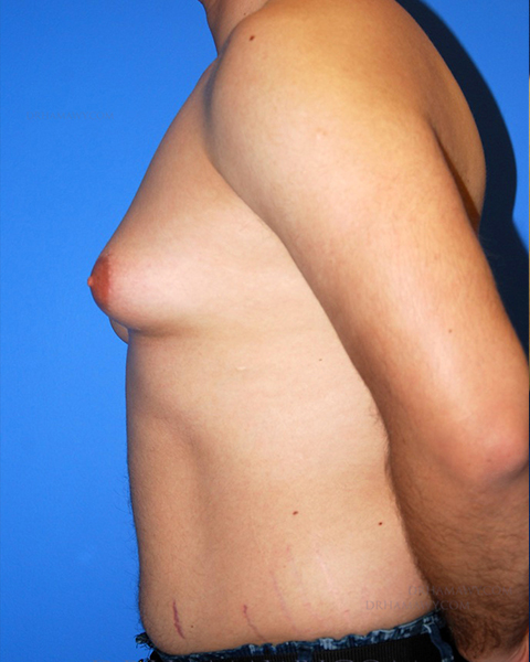 Male Chest Enhancement Before and After | Princeton Plastic Surgeons