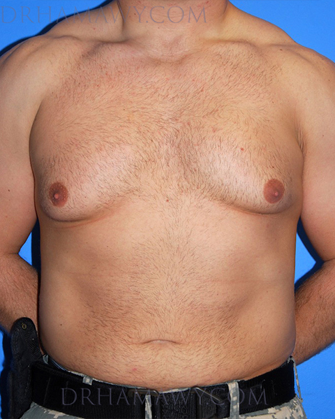 Male Chest Enhancement Before and After | Princeton Plastic Surgeons