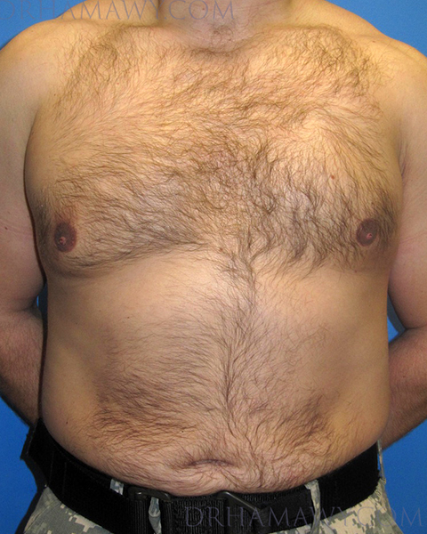 Male Chest Enhancement Before and After | Princeton Plastic Surgeons