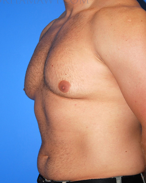 Male Chest Enhancement Before and After | Princeton Plastic Surgeons