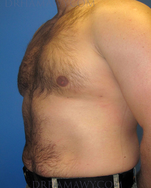 Male Chest Enhancement Before and After | Princeton Plastic Surgeons