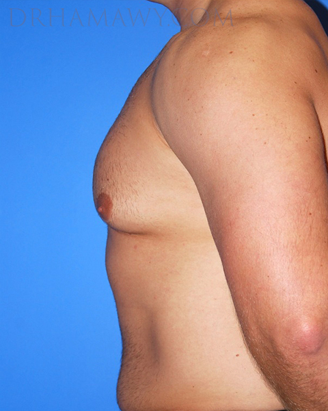 Male Chest Enhancement Before and After | Princeton Plastic Surgeons