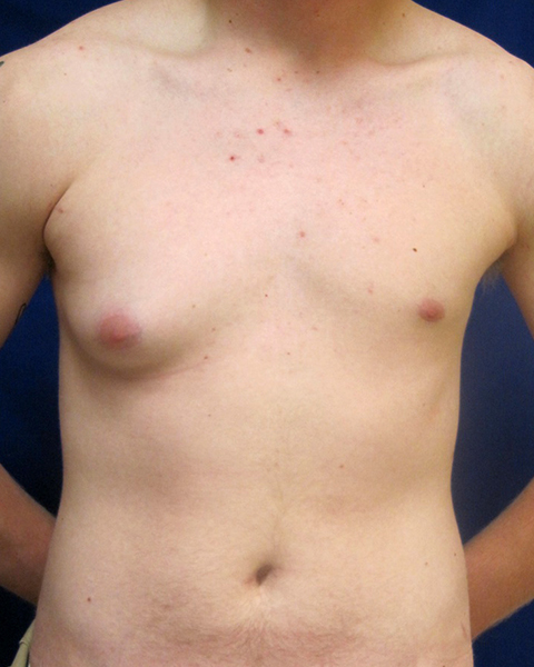 Male Chest Enhancement Before and After | Princeton Plastic Surgeons