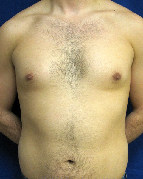 Male Chest Enhancement Before and After | Princeton Plastic Surgeons