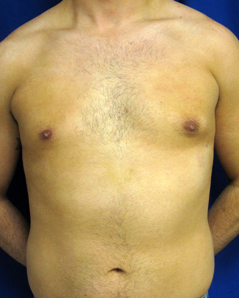 Male Chest Enhancement Before and After | Princeton Plastic Surgeons