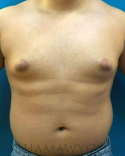 Male Chest Enhancement Before and After | Princeton Plastic Surgeons