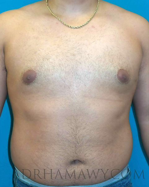 Male Chest Enhancement Before and After | Princeton Plastic Surgeons