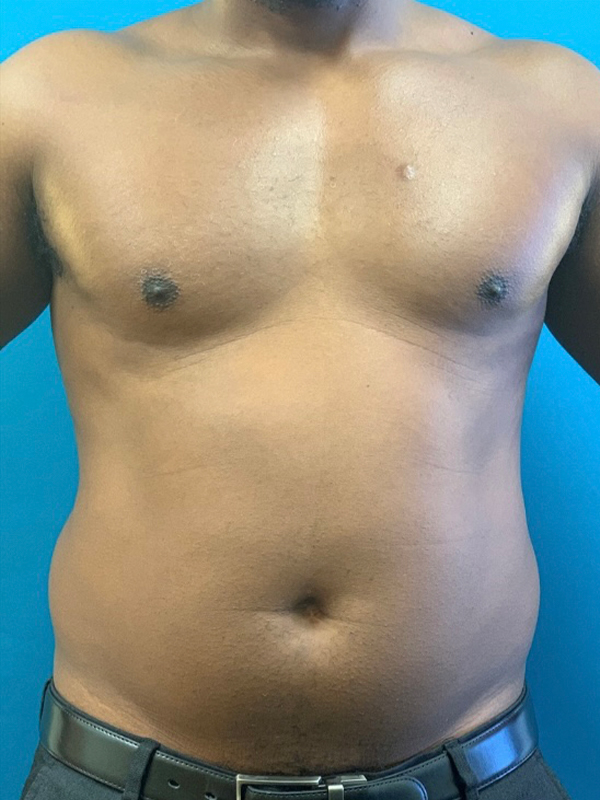 Male Chest Enhancement Before and After | Princeton Plastic Surgeons