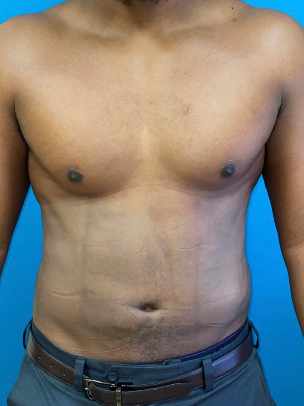 Male Chest Enhancement Before and After | Princeton Plastic Surgeons