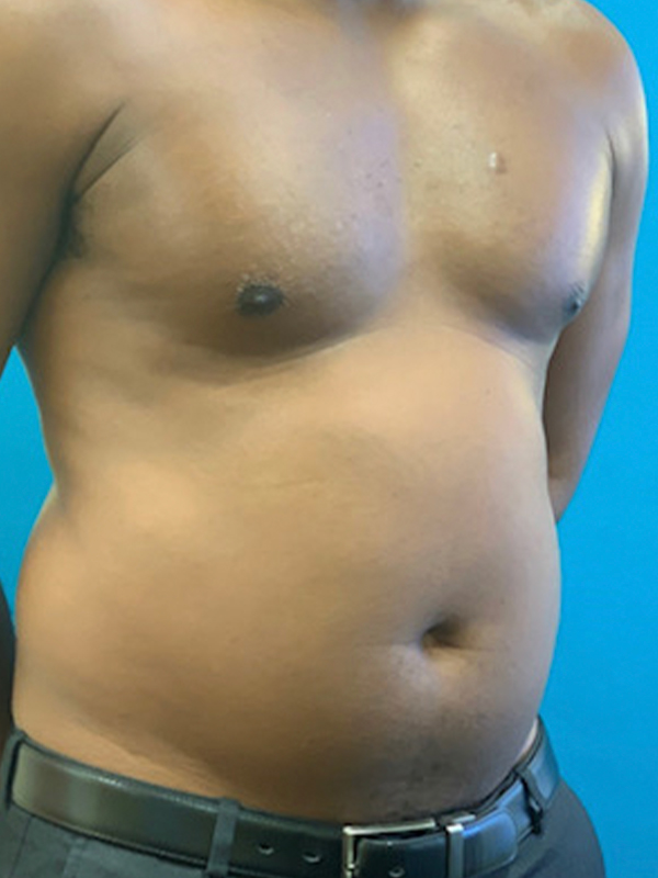 Male Chest Enhancement Before and After | Princeton Plastic Surgeons