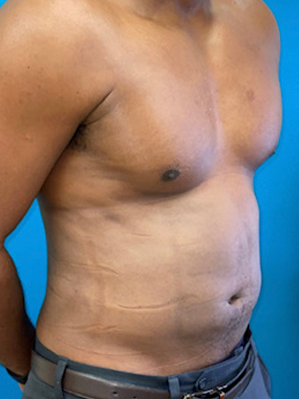 Male Chest Enhancement Before and After | Princeton Plastic Surgeons