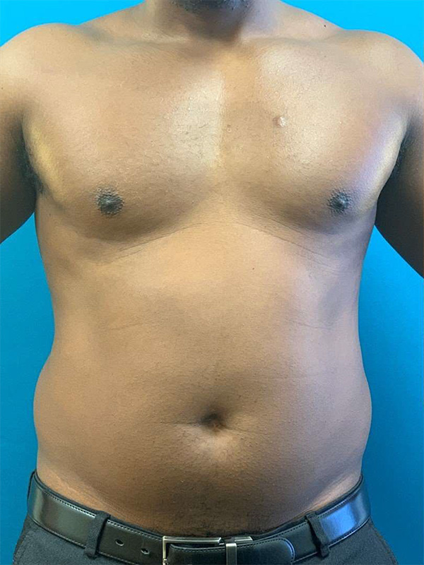 Male Lipo Before and After | Princeton Plastic Surgeons