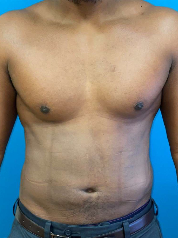 Male Lipo Before and After | Princeton Plastic Surgeons