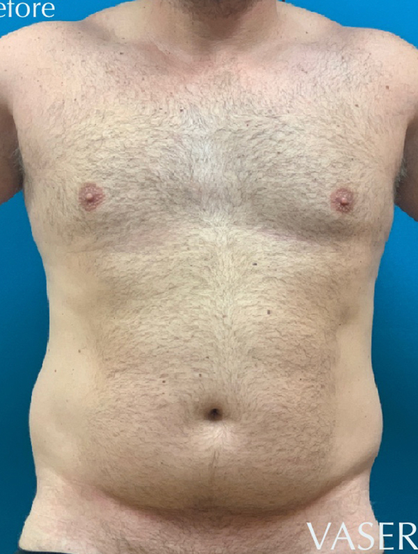 Male Lipo Before and After | Princeton Plastic Surgeons