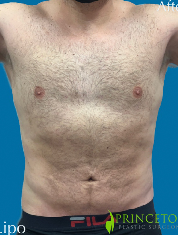 Male Lipo Before and After | Princeton Plastic Surgeons