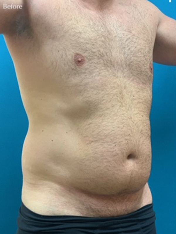 Male Lipo Before and After | Princeton Plastic Surgeons