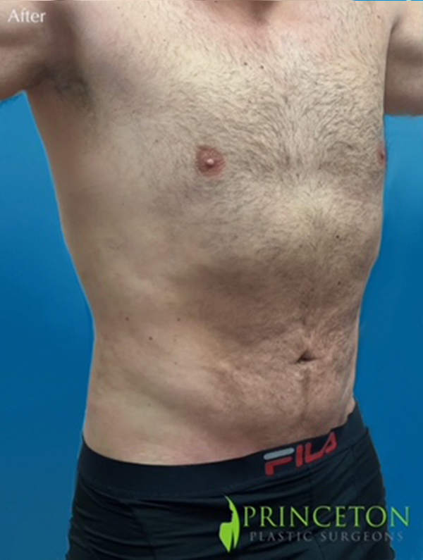 Male Lipo Before and After | Princeton Plastic Surgeons