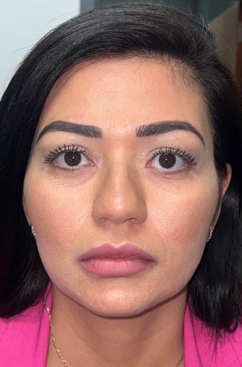 Nasolabial Fold Filler Before and After | Princeton Plastic Surgeons