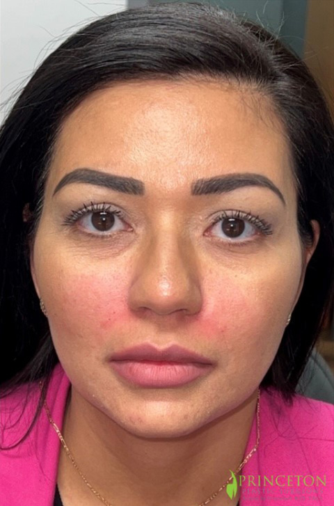 Nasolabial Fold Filler Before and After | Princeton Plastic Surgeons