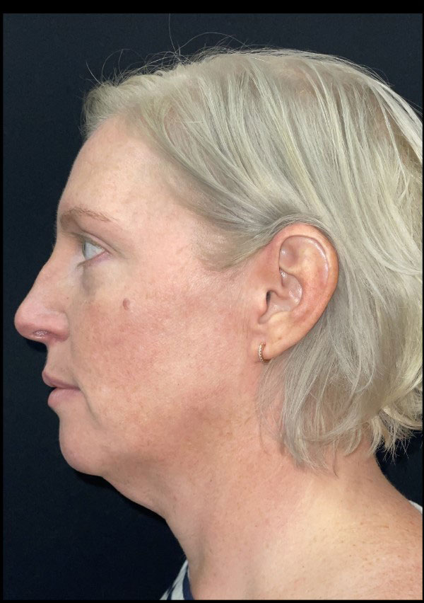 Neck Lift Before and After | Princeton Plastic Surgeons