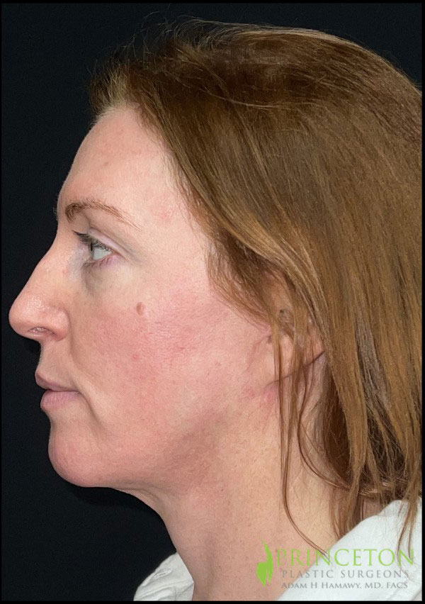 Neck Lift Before and After | Princeton Plastic Surgeons