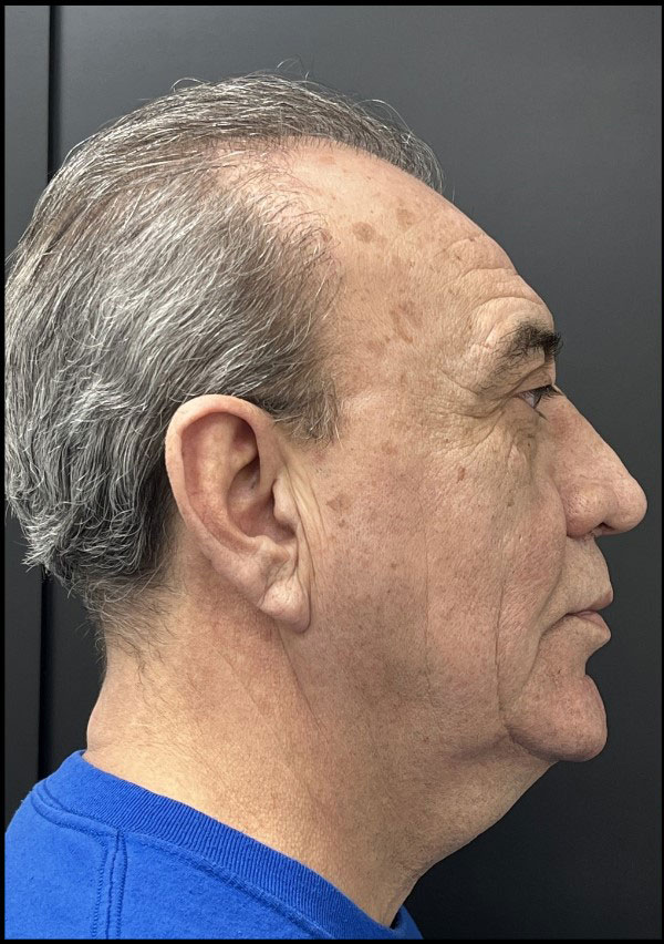 Neck Lift Before and After | Princeton Plastic Surgeons