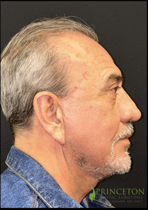 Neck Lift Before and After | Princeton Plastic Surgeons