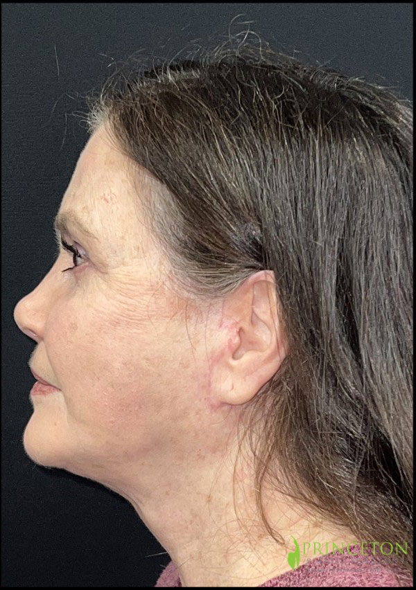 Neck Lift Before and After | Princeton Plastic Surgeons