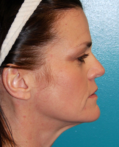 Neck Lift Before and After | Princeton Plastic Surgeons