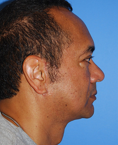 Neck Lift Before and After | Princeton Plastic Surgeons