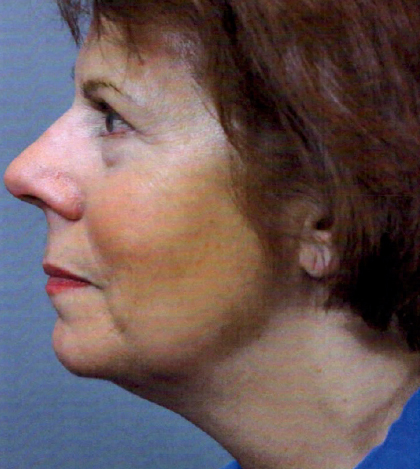 Neck Lift Before and After | Princeton Plastic Surgeons