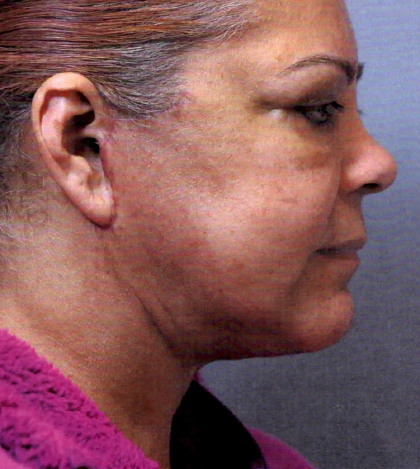 Neck Lift Before and After | Princeton Plastic Surgeons