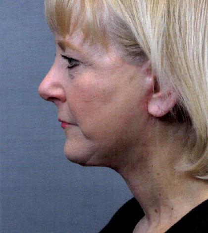 Neck Lift Before and After | Princeton Plastic Surgeons