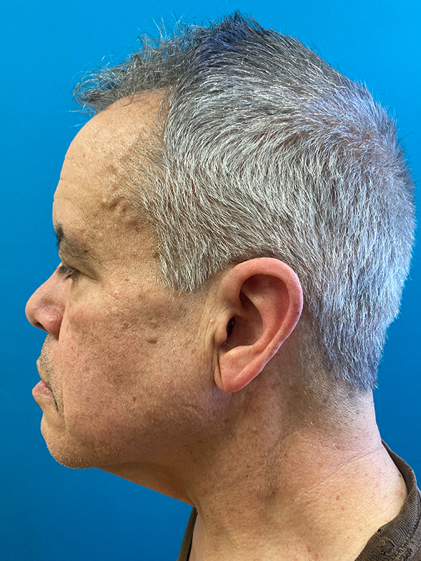 Neck Lift Before and After | Princeton Plastic Surgeons