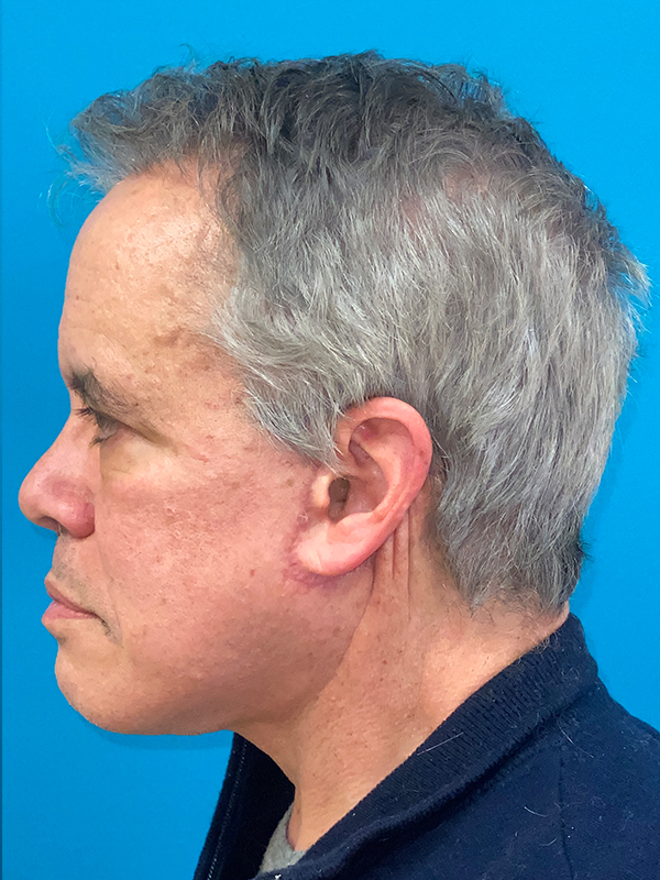 Neck Lift Before and After | Princeton Plastic Surgeons