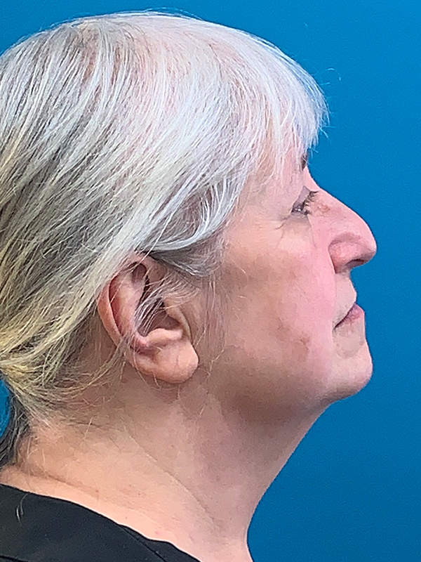 Neck Lift Before and After | Princeton Plastic Surgeons