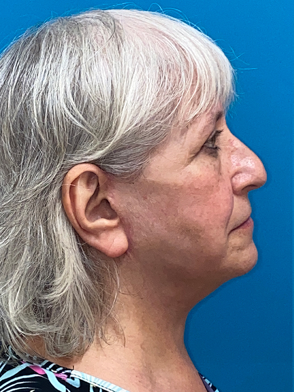 Neck Lift Before and After | Princeton Plastic Surgeons