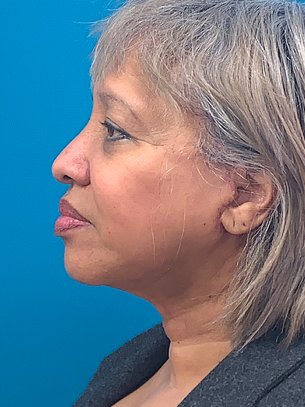 Neck Lift Before and After | Princeton Plastic Surgeons