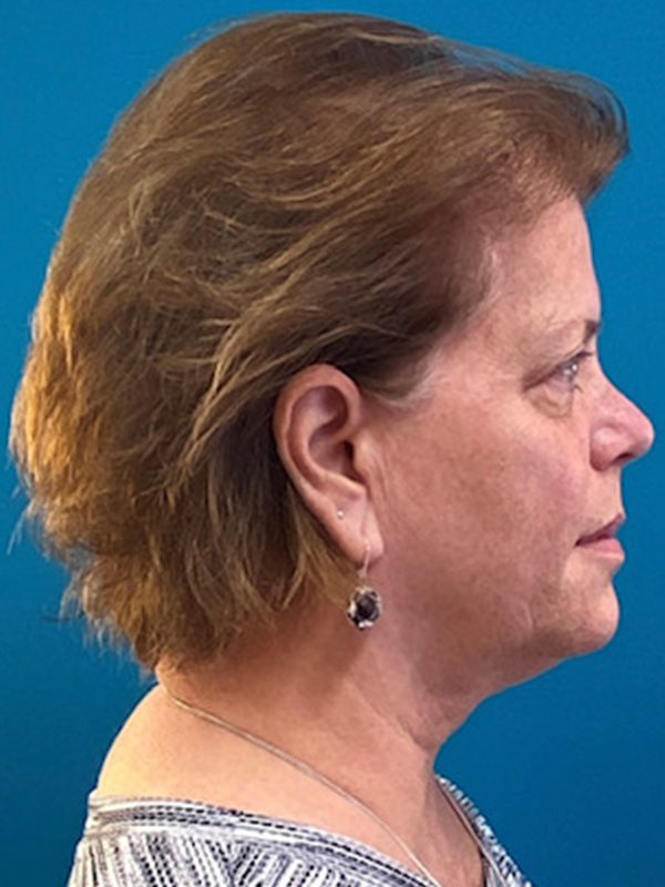 Neck Lift Before and After | Princeton Plastic Surgeons