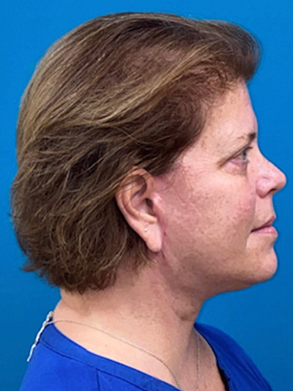 Neck Lift Before and After | Princeton Plastic Surgeons