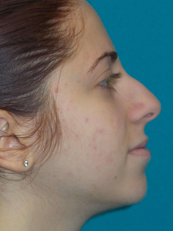 Rhinoplasty Before and After | Princeton Plastic Surgeons