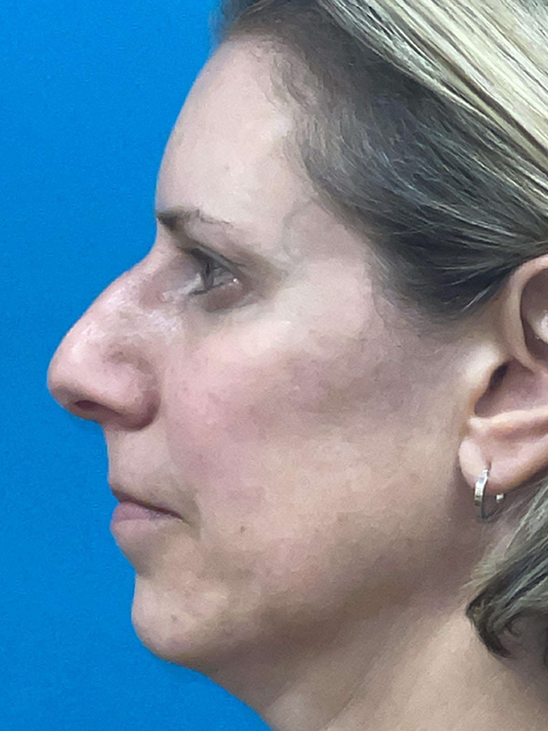 Rhinoplasty Before and After | Princeton Plastic Surgeons